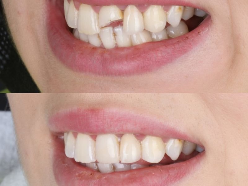 Cosmetic fillings