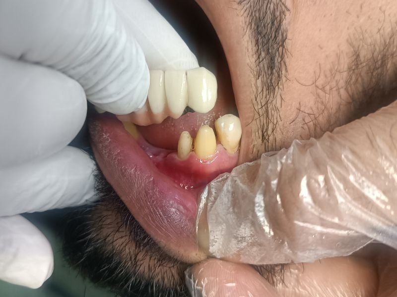 Dental crowns